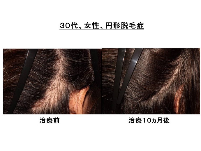 円形脱毛症　病院""